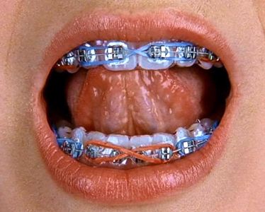 Faux Orthodontics